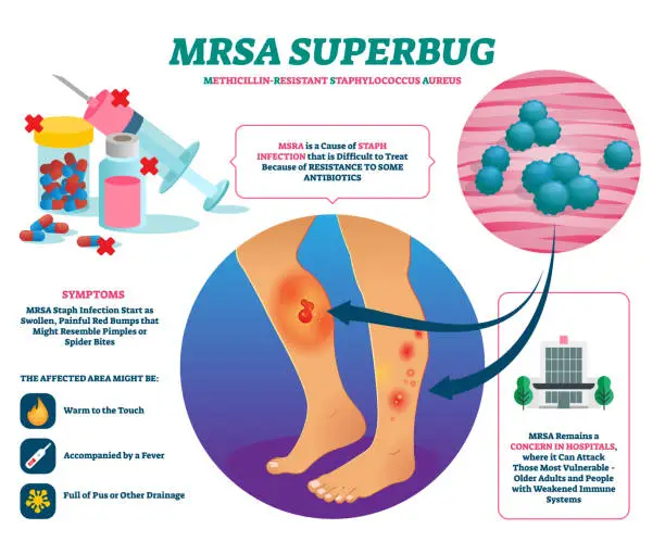 mrsa superbug symptoms