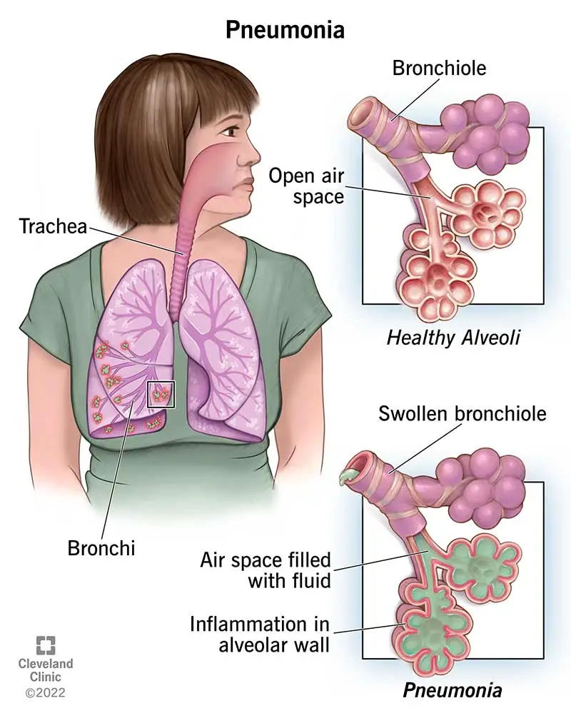 pneumonia symptoms